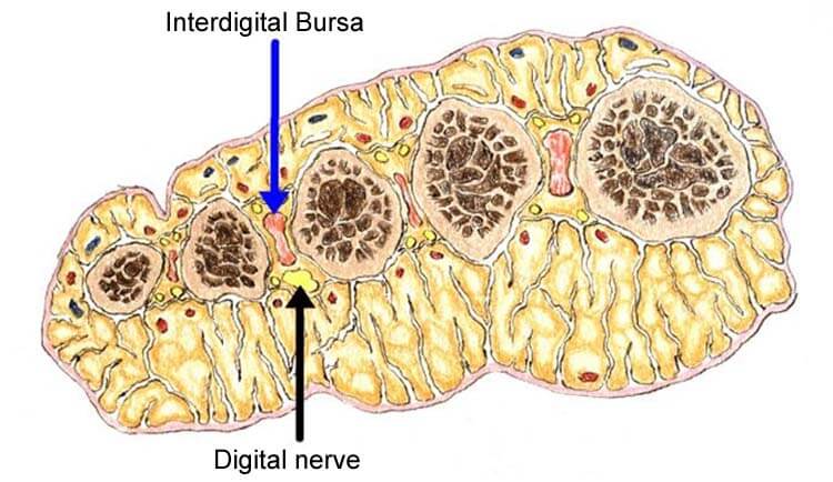 Morton's Neuroma