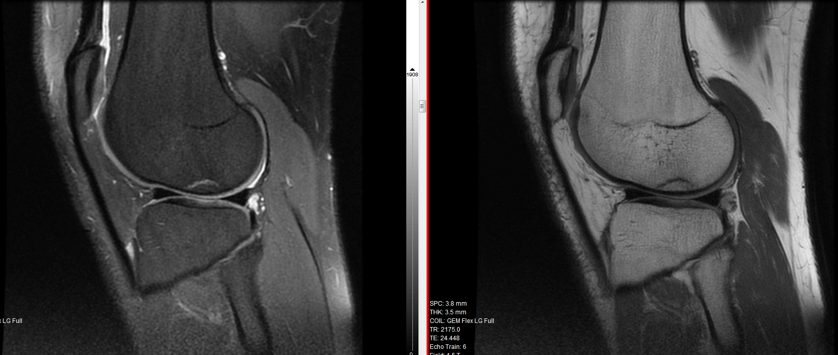 MRI Knee Stress Fracture