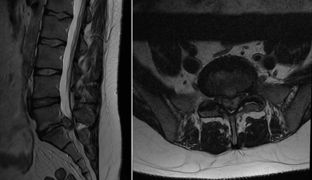 Large Lumbar Disc Prolapse